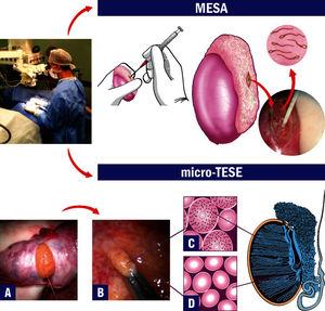 Microsurgical Sperm Retrieval Techniques. Operating microscope and microsurgical techniques are used throughout the procedures. The top image shows microsurgical epididymal sperm aspiration (MESA). After exposure of the testis and epididymis, a dilated epididymal tubule is dissected and opened. Fluid is aspirated, diluted with sperm medium and sent to the laboratory for examination. The bottom images show microsurgical testicular sperm extraction (micro-TESE). A) After the testicle is exteriorized, a single and large incision is made in an avascular area of the albuginea to expose the seminiferous tubules. B) Dilated tubules are identified and removed with microforceps (intraoperative photograph at 40X magnification). C) Illustration of the histopathology cross-section of a dilated seminiferous tubule with active spermatogenesis. D) Illustration of the histopathology cross-section of a thin tubule with Sertoli-cell-only syndrome.
