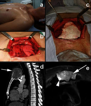 A) Clinical aspect before and after surgery; B) intraoperative aspect after sternum resection; C) intraoperative aspect after reconstruction; and D) CT sagittal reconstruction showing anterior focal cortical bone destruction and soft tissue extension (arrow). In the post-contrast image, it is also possible to identify a small region without contrast enhancement (arrowhead). E) Axial T2-weighted MRI revealed intermediate signal intensity predominance in the sternum giant cell tumor (arrow), although regions of high signal intensity were also present (arrowhead).
