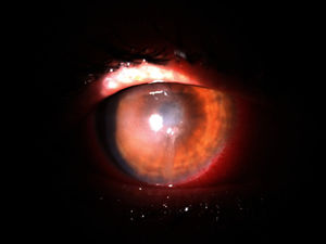 Central corneal keratitis in the right eye.