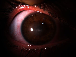 The infection resolved, but residual central stromal opacification remained in the right eye.