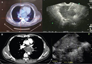 A A PET scan shows a 2-cm hypermetabolic lymph node (station 10R) in an 81-year-old male patient who had already been submitted to a lower right lobe segmentectomy (adenocarcinoma) 18 months prior. EUS-FNA (notice the needle piercing the lesion) demonstrated metastatic disease. B A 46-year-old male presented chronic cough attributed to gastroesophageal reflux. Subsequent hoarseness led to a CT scan that showed a large mediastinal mass in the subcarinal and paraesophageal stations. EUS-FNA was effectively used to diagnose epidermoid carcinoma.