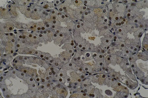 Immunohistochemical staining of PCNA on epithelial cells (FP60, original magnification 400X).
