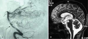 A) Cerebral angiography at admission revealed a small saccular aneurysm of the basilar artery near the emergence of the anterior inferior cerebellar artery (AICA). B) T2-weighted Magnetic Resonance Imaging (MRI) at the one-year follow-up revealed cerebellar atrophy.