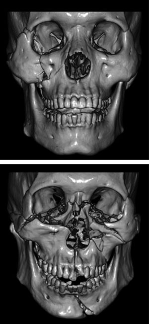 (A) A 26-year-old man with earthquake-related head trauma caused by a collapsed building in the Sichuan earthquake. The volume-rendering image shows fractures involving the right orbit, zygomata and maxilla. (B) A 40-year-old man with head trauma caused by a traffic accident. The volume-rendering image shows multiple fractures involving the bilateral orbits, zygomata, nasal bone, left maxilla and mandible, and the bilateral maxillas are detached.