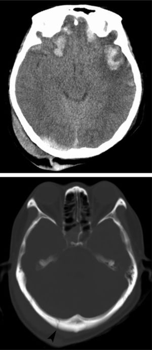 A 30-year-old woman with head trauma caused by a collapsed building in the Sichuan earthquake. (A) There is an extradural hematoma in left frontal region. (B) A CT image shows a depressed fracture of the left front bone.