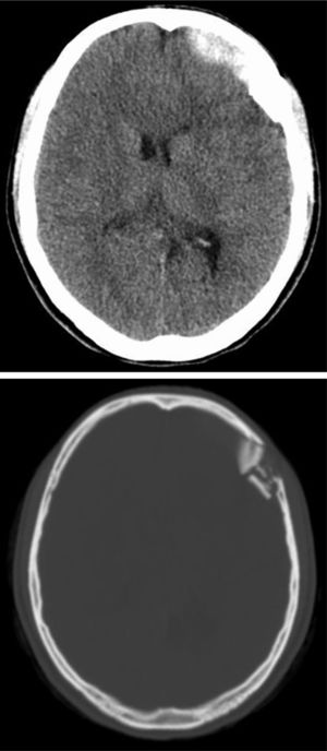 A 26-year-old woman with head trauma caused by a traffic accident. (A) There are many cerebral contusions and lacerations in the bilateral frontal lobes and an extradural hematoma in the right occiput. The right occipital scalp is swollen. (B) The right occipital bone is fractured (black arrowhead).