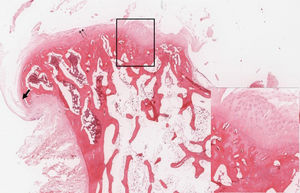 Group A specimen. Image shows focal thickening of the articular cartilage and the cortical bone (insert) with a deformed articular surface. Fissuring (double arrows) and osteophytes (arrow) are shown (H & E stain).- Group A specimen. Image shows focal thickening of the articular cartilage and the cortical bone (insert) with a deformed articular surface. Fissuring (double arrows) and osteophytes (arrow) are shown (H & E stain).