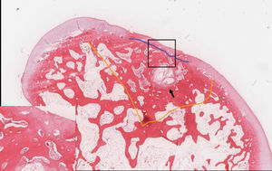 Group B specimen. Image shows a continuous surface and erosion of the regenerated hyaline cartilage (insert) in the central zone of the original defect area (area within the orange line). A cystic space (arrow) that was filled with granulation tissue in the subchondral area (blue line) with sclerosing change is shown (H & E stain).- Group B specimen. Image shows a continuous surface and erosion of the regenerated hyaline cartilage (insert) in the central zone of the original defect area (area within the orange line). A cystic space (arrow) that was filled with granulation tissue in the subchondral area (blue line) with sclerosing change is shown (H & E stain).
