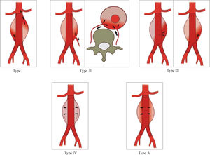 Illustration of endoleaks using the Veith classification (Veith et al.4).