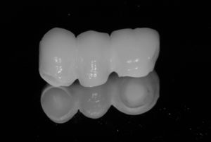 Three-unit, all-ceramic prostheses for 14-16 rehabilitation crowns for implants. The zirconia core was surrounded by feldspathic ceramic.