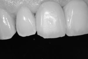 Minor chipping of the anterior zirconia prosthesis on tooth 11.
