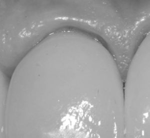Poor gingival response at the 1-year follow-up.