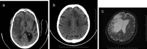 a. CT scan from patient 1. Note an ischemic stroke of the M1 segment of the middle cerebral artery with a small hemorrhagic transformation in the perforating arteries territory. b. CT scan from patient 2 showing infarcts in branches of left anterior and middle cerebral arteries. c. MRI scan from patient 3 with an area of right frontotemporal encephalomalacia, 1.6 years after the surgical clipping of a right middle cerebral artery aneurysm.