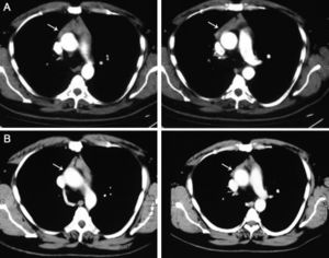 CT-scan images showing a thymus enlargement before (A) and after (B) treatment for hyperthyroidism due to Graveś′ disease, with remarkable shrinkage of the thymus (arrows).