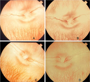 Fundus photography of a control (A) and treated (C) eyes before the intravitreal injection of bevacizumab. A repeat photograph taken seven days after treatment did not reveal abnormalities in either the control (B) or treated (D) eyes.