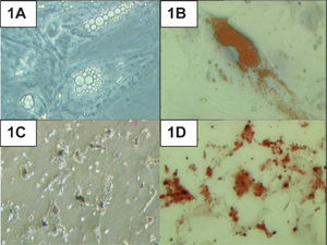 Human adipose-derived stem cells (HADSCs) cultured in adipogenic and osteogenic induction media. (A) Lipid droplet production in HADSCs after 21 days of adipogenic induction. (B) Positive Oil Red O staining of the lipid droplets. (C) Calcium deposition in HADSCs after 21 days of osteogenic induction. (D) Positive Alizarin Red staining. Magnification 400X.