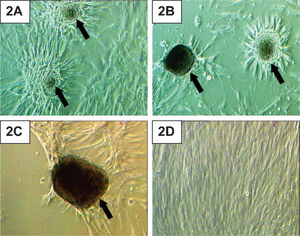 Human adipose-derived stem cells (HADSCs) cultured in a chondrogenic induction medium. (A) After one week of chondrogenic induction, HADSCs showed early cell condensation (arrow). (B) Cell aggregates (arrow) became larger in size and started to store matrices during the second week of chondrogenic induction. (C) Cell aggregates (arrow) became dense and dark in color, which denoted increased matrix deposition at the third week of culture in a chondrogenic induction medium. (D) HADSCs grown in a control medium did not show any cell aggregation after three weeks in culture. Magnification 200X.