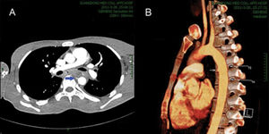 CT angiography images. A) Mediastinal esophageal fistula with inflammatory exudate surrounding the descending aorta (arrow). B) An aortic pseudoaneurysm at the anterior wall of the descending aorta at the lower edge of thoracic vertebrae 5 (arrow).