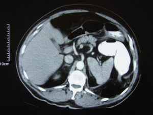 Axial CT scan shows 6-cm opening at the posterior segment of the diaphragm. Transvers colon and surrounding fat tissues enter thorax through the diaphragmatic defect. The entering segment of the colon is narrowed. These changes displace diaphragm, spleen and surrounding fat tissues anteriorly.