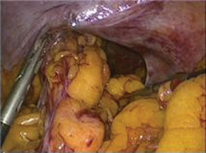 The view of the diaphragmatic defect after the bowel segment was reduced.
