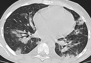 A 10-year-old boy with a confirmed diagnosis of H1N1. Computed tomography images performed 4 days after the onset of the symptoms demonstrate moderate peribronchovascular and subpleural consolidation predominant in the lower lobes. The boy developed respiratory failure and received mechanical ventilation for 19 days. The duration of viral shedding in this patient was 23 days, and he died 30 days after the onset of clinical symptoms.