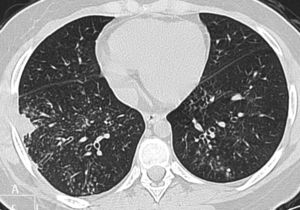 A 15-year-old girl with mild respiratory symptoms and a confirmed diagnosis of H1N1. A computed tomography scan performed at the carina level shows centrilobular nodules and a tree-in-bud pattern heterogeneously distributed through the lungs, as well as a pleural-based consolidation in the right lower lobe. The girl recovered without the need for admission to the Intensive Care Unit.
