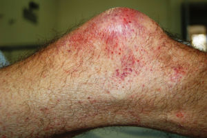 Ecchymosis, perifollicular hemorrhage, and corkscrew hairs in the right knee.