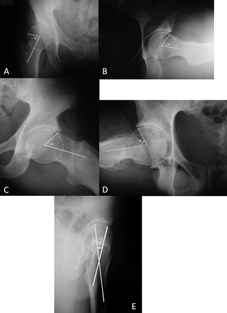 A comparative radiographic investigation of femoroacetabular ...