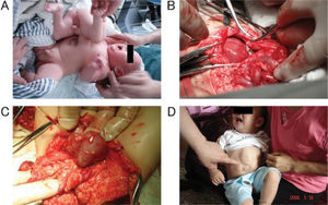 (A) The parasitic twin in case 1 had a fully developed pelvis, two pairs of limbs, and a well-developed penis, which produced urine discharge. (B) The livers of the parasite and autosite were physically attached in case 1. (C) The parasitic twin in case 1 contained a pair of well-developed kidneys. (D) The autosite in case 1 during the twelfth month after the operation to remove the parasitic twin.