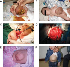 (A) Large hernia of the abdominal wall (H), omphalocele (O) and limbs (L) of the parasitic twin in case 2. (B) View of the hernia in case 2. The parasitic twin was excised, and the omphalocele was repaired. (C) The pelvis of the parasitic twin in case 2 contained one small kidney and a cyst. (D) The hernia in case 2 was repaired using VYPRO II mesh. (E) Condition of the repaired ventral hernia in case 2 at 14 days after surgery. (F) The autosite in case 2 during the twenty-third month after the operation to remove the parasitic twin.