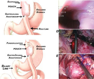 The proposed technique: A - Surgical anatomy post-RYGB. B - Surgical anatomy post-fundoplication. The LES was reinforced by wrapping the excluded stomach around the lowest portion of the esophagus. C - Endoscopic view of the 3.5-cm pouch and the 13-mm GJ. D - Endoscopic-guided fundoplication delimiting the z-line (arrow shows transillumination with the endoscope). E - Final result of the 360° short, floppy fundoplication. Abbreviations: RYGB – Roux-en-Y gastric bypass; LES – lower esophageal sphincter; GJ – gastrojejunostomy.
