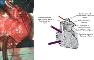 Photograph and diagrammatic schema of the cannulation of the brachiocephalic trunk and double venae cavae for extracorporeal circulation (ECC). A tourniquet was placed in the left carotid, the left subclavian artery and the descending aorta. ECC was initiated, and the DA was ligated. A clamp was placed at the aortic arch, isolating the ascending aorta and the brachiocephalic trunk from the systemic circulation. The tourniquets were then closed. A flap was created in the semilunar section in the initial portion of the anterior pulmonary trunk 3 cm above the pulmonary valve. A second semilunar incision was made in the anterosuperior side of the arch of the aorta near the left carotid and left subclavian arteries, creating the second flap.