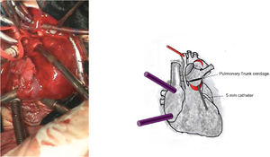 A photograph and diagrammatic schema of the introduction of a 5 mm catheter through the opening of the pulmonary trunk, toward the pulmonary arteries. We placed the pulmonary trunk cerclage around this catheter using cardiac tape sutured with 5-0 Prolene.