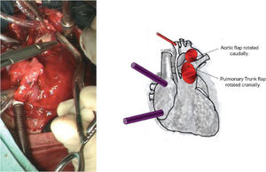 A photograph and diagrammatic schema. The aortic flap was rotated caudally, and the pulmonary trunk flap was rotated cranially. These flaps were sutured edge-to-edge with 7-0 Prolene, originating the autologous posterior wall of the neo-aorta.