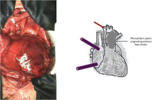 A photograph and diagrammatic schema. The implantation of a valved bovine pericardium patch from the anterior opening of the pulmonary trunk to the aortic arch, extending to the beginning of the descending aorta resulting the anterior wall of the neo-aorta.