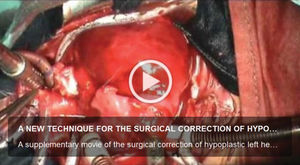 A supplementary movie 1 of the surgical correction of hypoplastic left heart syndrome (stage 1) performed with the new proposed technique. http://dx.doi.org/10.6061/clinics/video01.