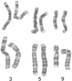 Partial G-banded karyotypes of the familial rea(3;5;9)(p24.3;p13.1p15.2;q22). Upper row: the child's unbalanced karyotype, with only the 5 and 9 derivatives; the patient had a duplication of 3p24.3→pter concomitant with a deletion of 5p15.2→pter. Lower row: the mother's balanced karyotype, with all three derivatives. Except for the patient's normal pair 3, the derivative is on the right in each pair.