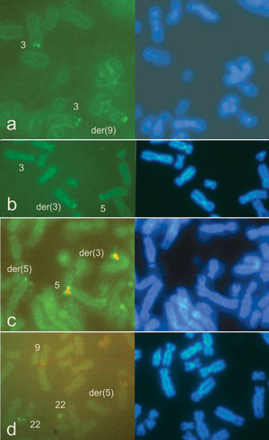 FISH karyotype analyses of the patient (a) and his balanced mother (b-d). a: The 3p subtel probe (green) hybridized to both the normal 3 and the der(9). b: The 5p subtel probe (green) hybridized to both the normal 5 and the der(3). c: The combined cri du chat (green/red)/Sotos (green) probe confirmed the translocation of 5p15.2→pter onto 3p24.3; i.e., the der(3) had both 5p or cri du chat signals, whereas the der(5) exhibited only the 5q35 Sotos signal. d: The ABL (red)/BCR probe (green) hybridized to both the normal 9 and the der(5) and to both copies of chromosome 22. DAPI counterstained images are on the right.