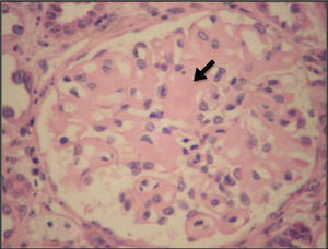 Kidney biopsy, hematoxylin-eosin, and light microscopy. Enlarged hypocellular glomerulus with deposits of amorphous material (arrow). Magnification 300x.