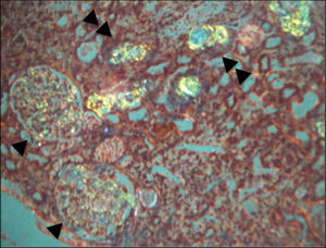 Congo red staining shows apple-green birefringence on glomeruli (arrowheads) and tubules (double arrowheads). Not shown: tubules with degenerative changes, focal areas of necrosis and areas of interstitial nephritis. Normal blood vessels.