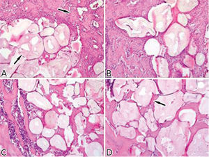 Histology of tibias implanted with PLLA/PEO that were A) vancomycin-loaded or B) vancomycin-unloaded on the 4th day, showing evident granulation tissue around the microspheres (arrow) with the initial replacement by bone formation (arrow). This figure also shows the histology of the tibias of animals implanted after 12 days with PLLA/PEO that were C) vancomycin-loaded or D) vancomycin-unloaded, showing trabecular bone encasing the microspheres (Original H&E 10×).