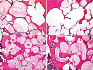 Histology of tibias implanted with PLLA/PEO that were A) vancomycin-loaded or B) vancomycin-unloaded after 4 weeks, showing thin trabecular bone (arrow); and PLLA/PEO that were C) vancomycin-loaded or D) vancomycin-unloaded during a 32-week period, showing massive bone formation surrounding the microspheres with evident maturation and the presence of lamellar bone (arrow) (Original H&E 10×).