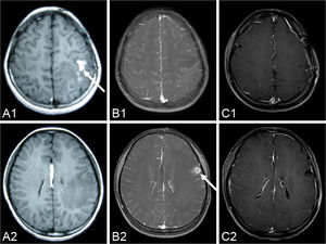 A series of pre-operational MR images demonstrates the local migration of an irregular, enhanced lesion (arrow) in the left hemisphere (A1-A2) six months before the operation; (B1-B2) three days before the operation. The lesion disappears in the post-operation MR images over the two-year follow-up period (C1-C2) 26 months after the operation.