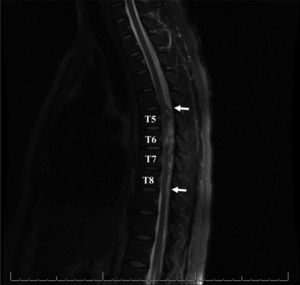 Magnetic resonance imaging of the thoracic spine. Sagittal T2-weighted imaging reveals a hyperintense posterior mass extending from T5-T6 to T7-T8 (white arrows), which compresses the spinal cord anteriorly.