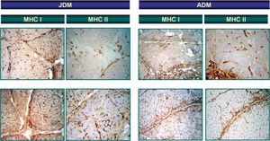 Major histocompatibility complex I and II expression in muscle fibre membrane surface of juvenile and adult dermatomyositis. Notes: The immunohistochemistry analysis demonstrates significantly higher major histocompatibility complex I expression in fibres of juvenile dermatomyositis compared to adult dermatomyositis, in contrast to major histocompatibility complex II expression.