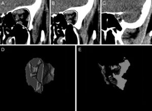 A, B and C. Examples of the area outlined on 3 coronal slices of computed tomography scans, from which measurements were obtained. Representation of the soft tissue (mostly muscles) (D) and orbital fat (E) apical volumes based on sequential coronal orbital slices.