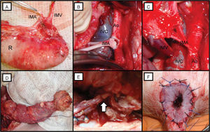 (A) An anorectal graft showing the inferior mesenteric artery (IMA) and vein (IMV) and the rectum (R). (B) The infrarenal aorta (Ao) and vena cava (IVC) were cross-clamped at the site of anastomosis. (C) The anastomoses between the Ao and IMA and between the IVC and IMV. (D) The anorectal graft following reperfusion. (E) Pudendal nerve anastomosis (arrow head). (F) Anal anastomosis in the perineum.