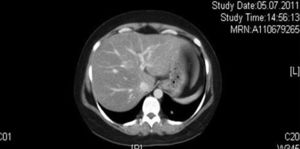 Computerized tomography of the bronchial carcinoid.