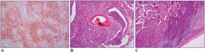 A) ACTH staining of bronchial cells. B) Vascular invasion by tumor cells. C) Lymphoid invasion by tumor cells.
