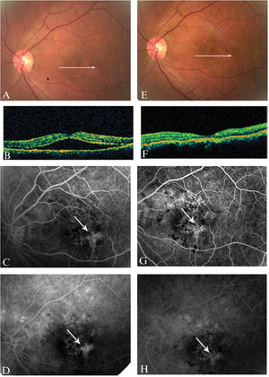 Serous detachment in the macular region (A) that was suggestive of CSC and subsequently confirmed with OCT (B). Diffuse hyperfluorescent spots in the macular region and a number of leaks were observed upon fluorescein angiography imaging (C-D). Fundoscopy (E) and OCT imaging (F) indicated resolution of the serous detachment. The macular leaks were found to be diminished using fluorescein angiography, but the hyperfluorescent spots persisted (G-H).